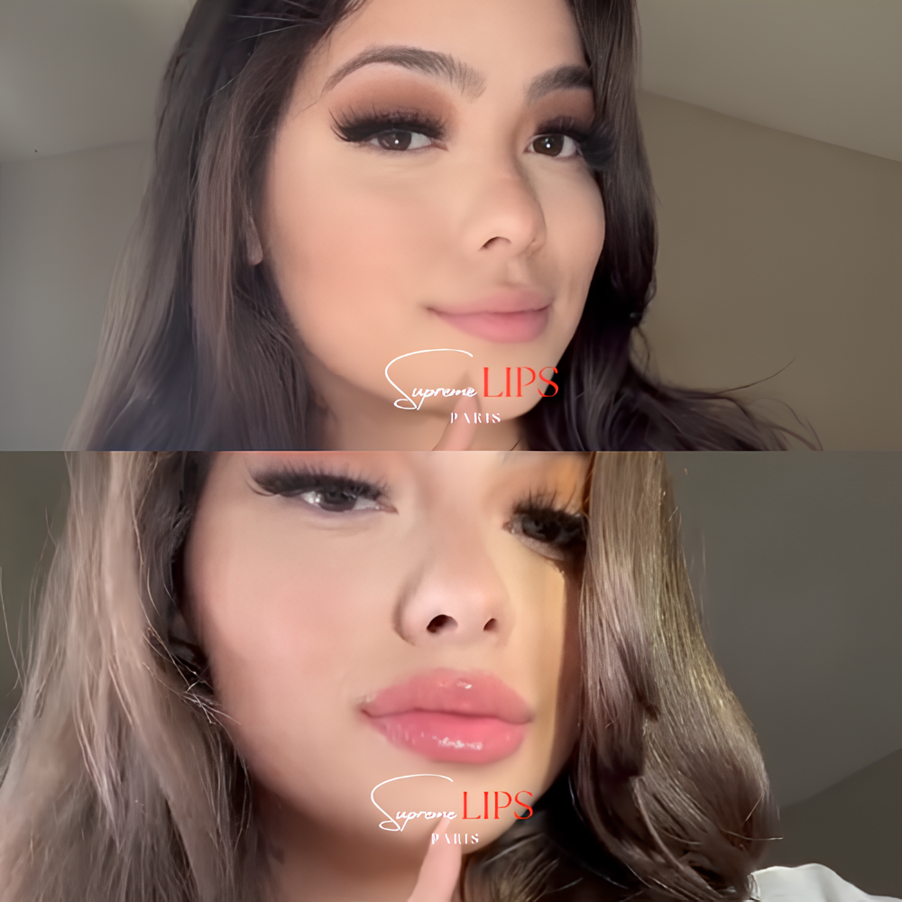 SUPREME LIPS POWIĘKSZACZ DO UST